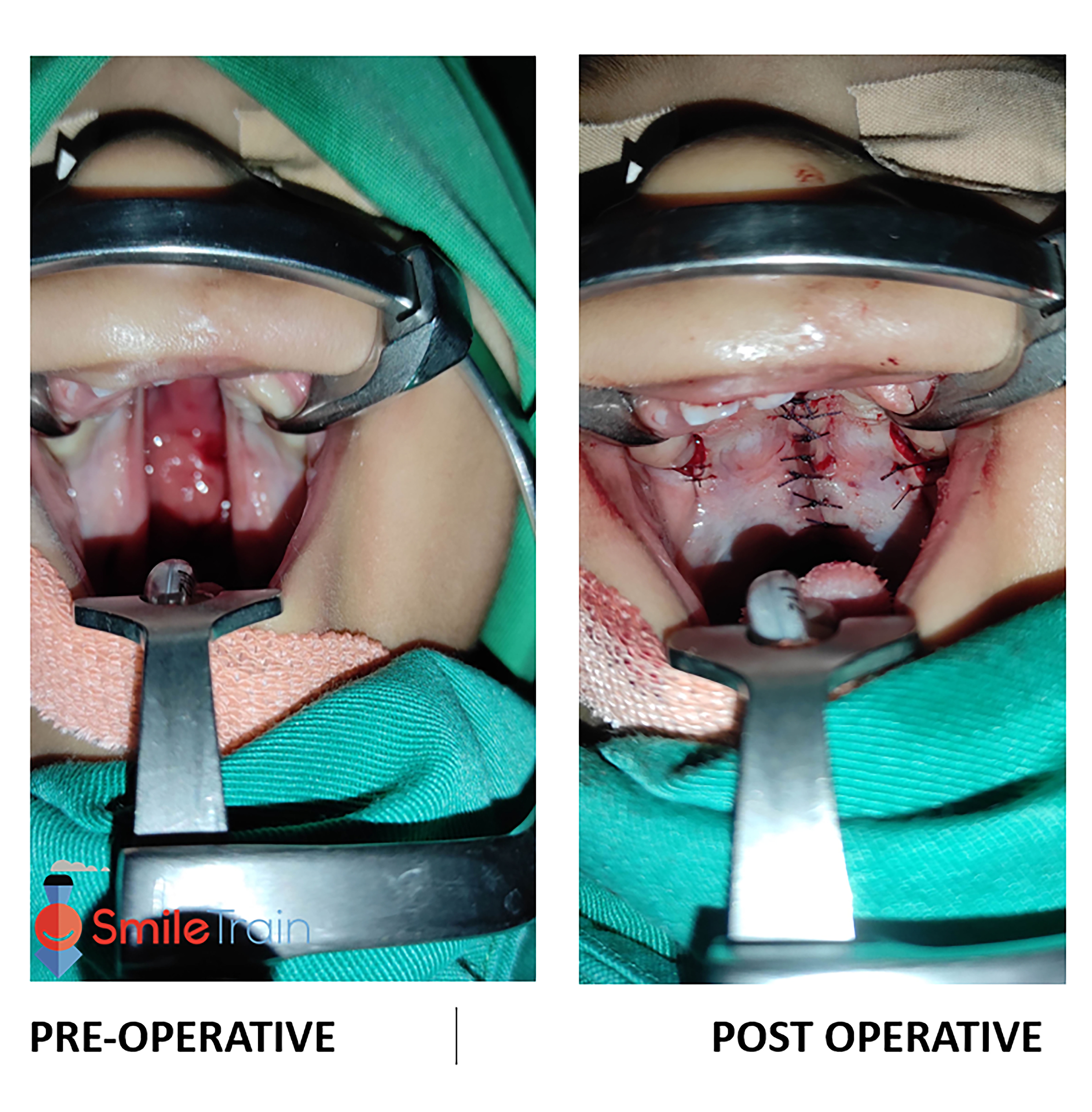 Cleft Palate